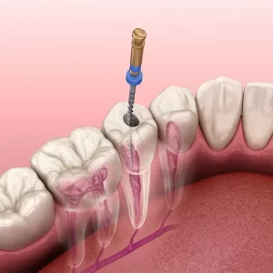 A root canal treatment session