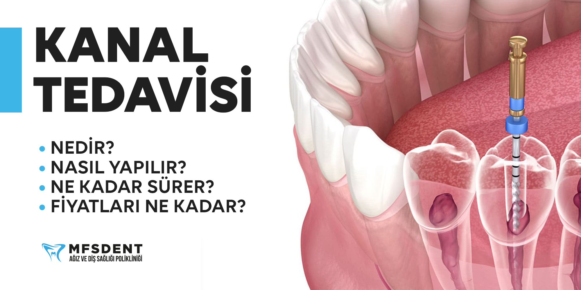Root Canal Treatment: What It Is and What It Costs