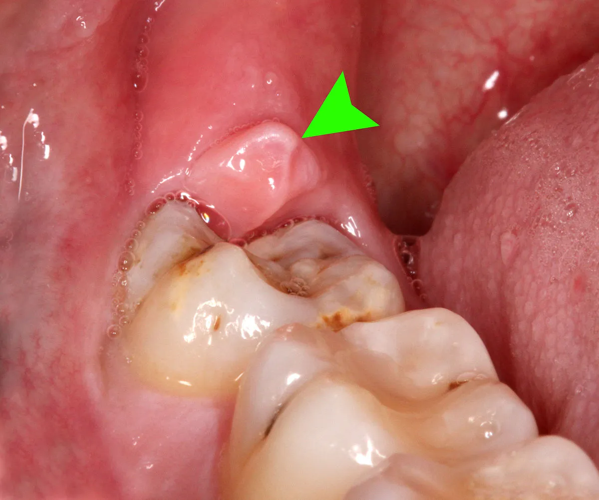 Gum swelling and jaw pain as signs of a wisdom tooth erupting