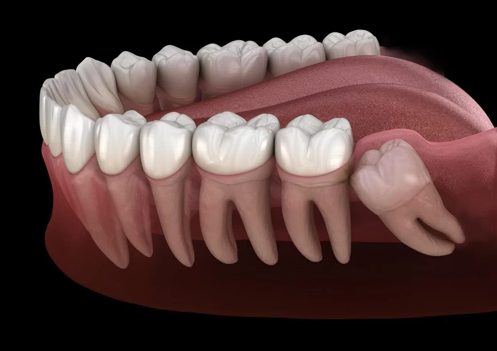 A wisdom tooth (third molar) erupting at the very back of the jaw