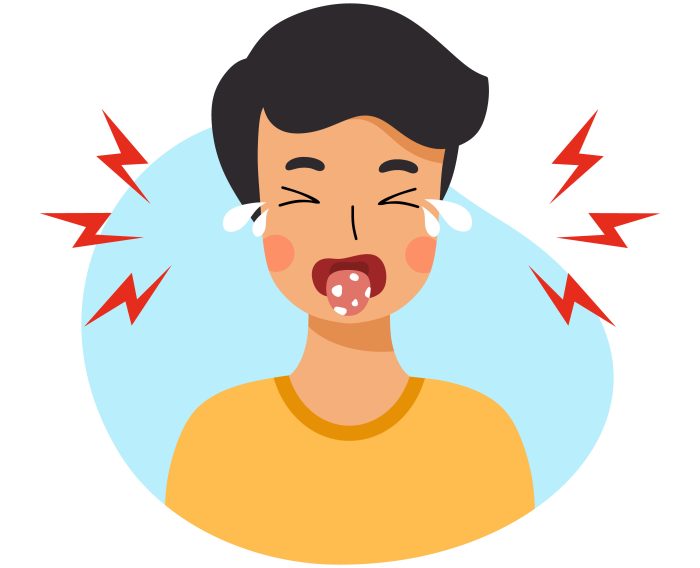 Thrush plaques on a baby's tongue and inside the cheek