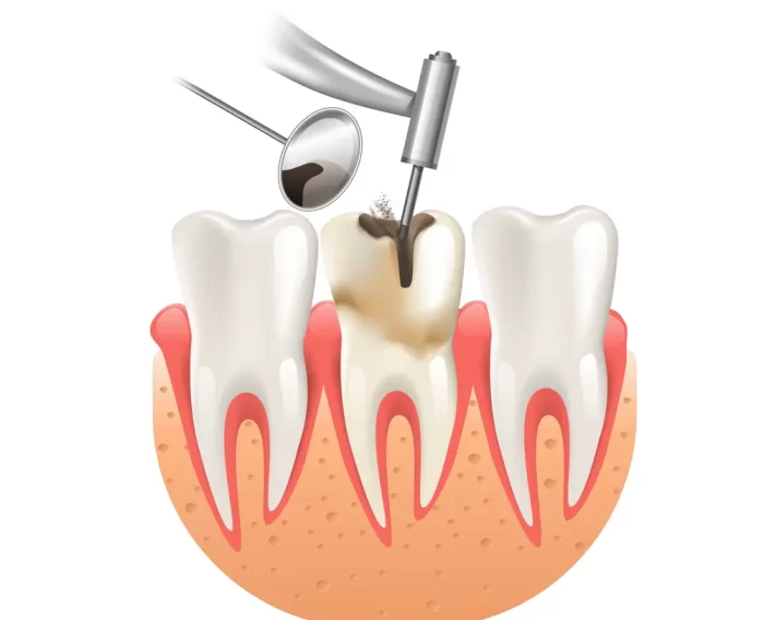 Dental filling being placed by a dentist