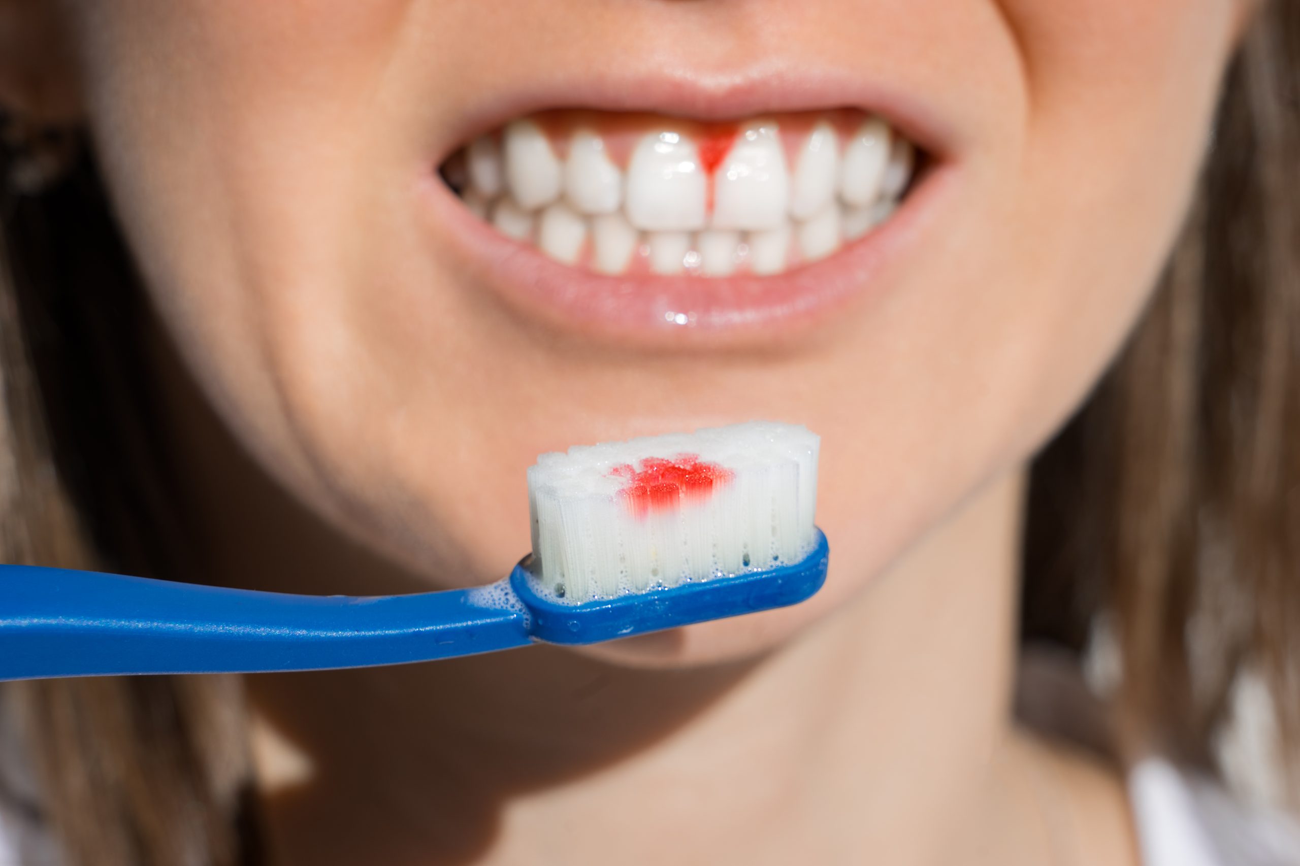 Gums bleeding during brushing