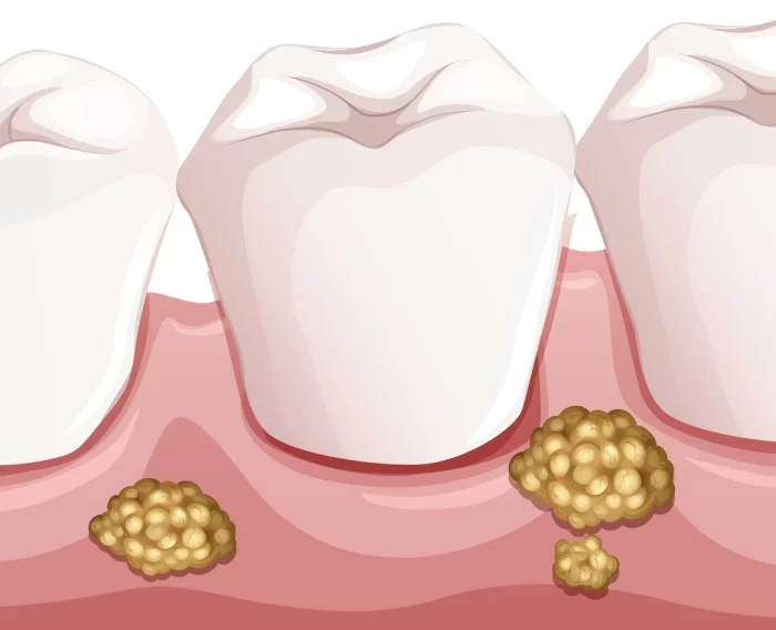 Appearance of oral thrush inside the mouth and on the tongue