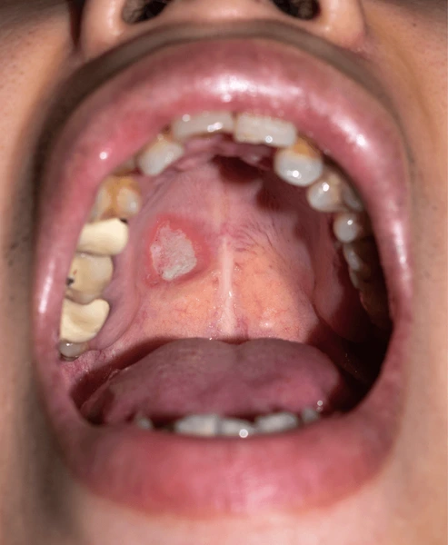 Person with a palate sore: what helps a sore on the palate