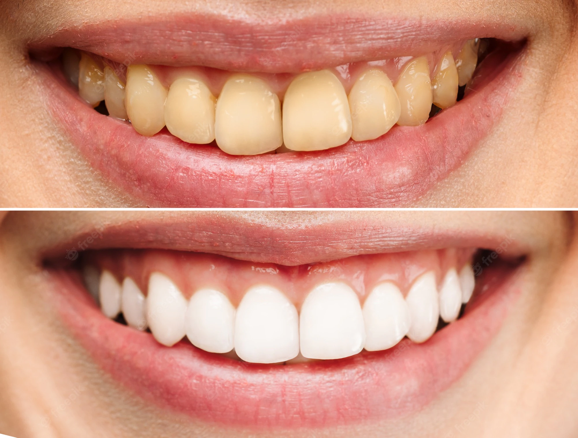 Care advice after a teeth cleaning