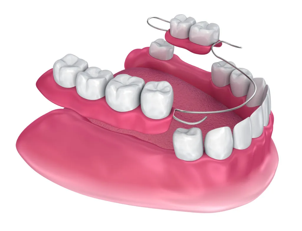 Removable false teeth that the patient can take out