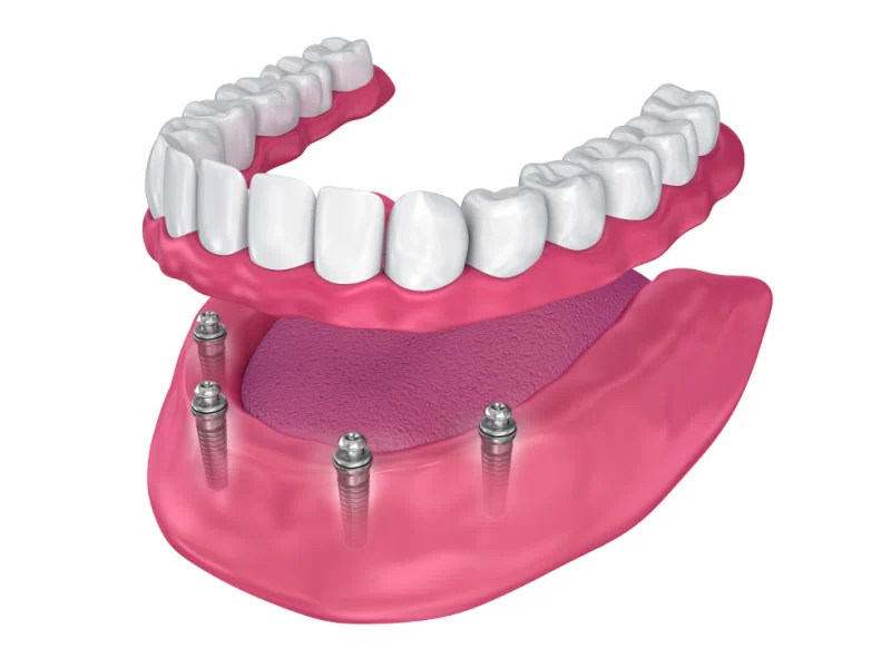 An implant-supported denture attached to implants in the jawbone
