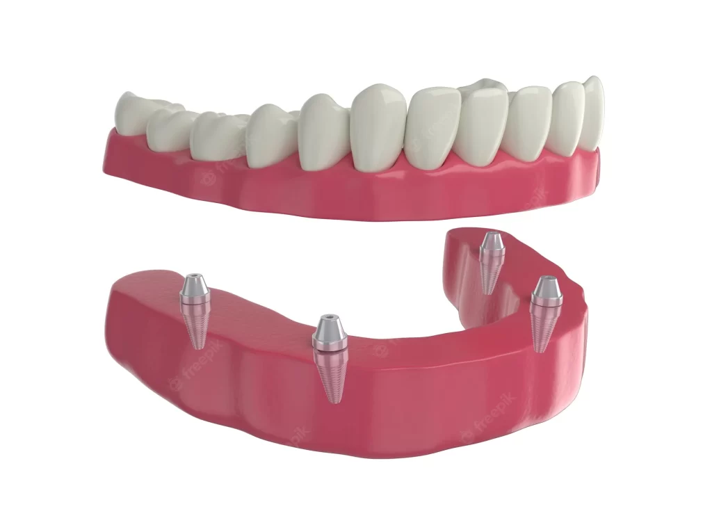 Full, partial and implant-supported denture types