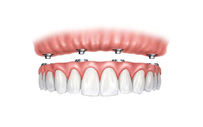 A fixed denture made up of a crown and a bridge