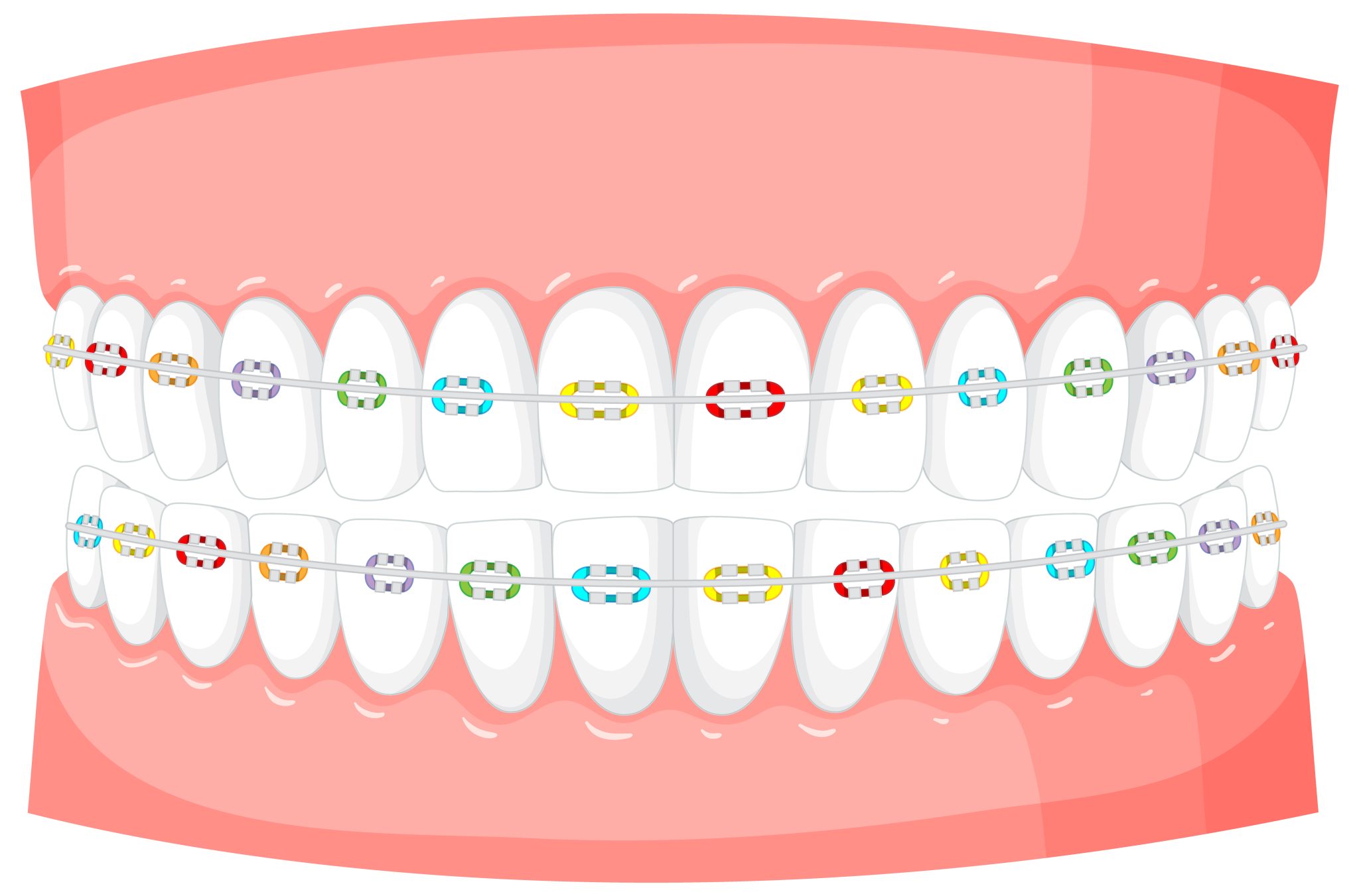 Metal, ceramic and lingual types of braces