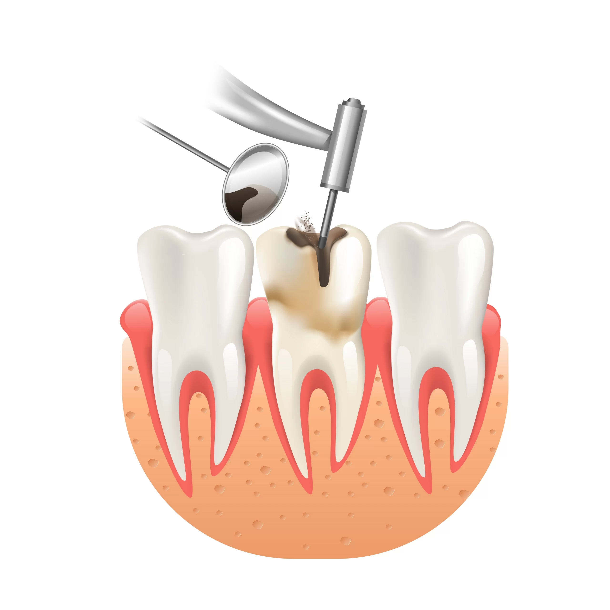 Endodontics: the pulp and root canal structure of a tooth