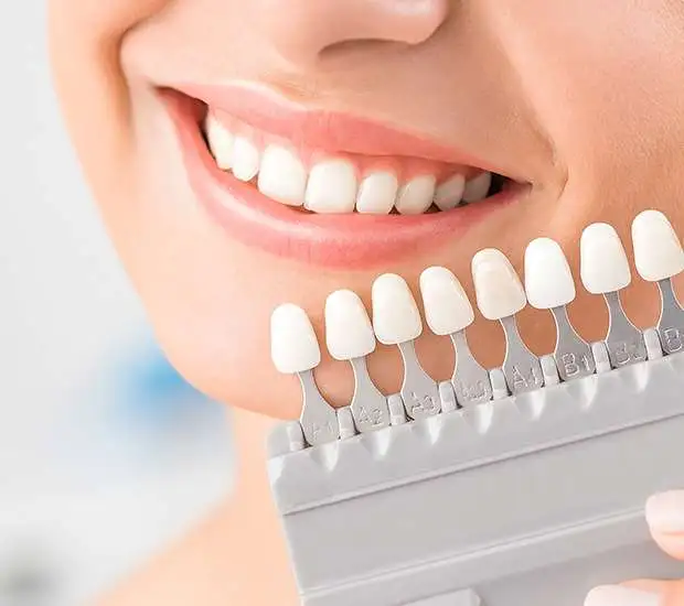 Thin veneer restoration bonded to the visible surface of a front tooth