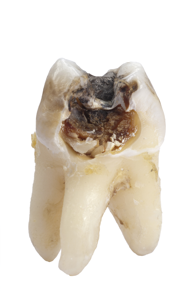 Broken front tooth