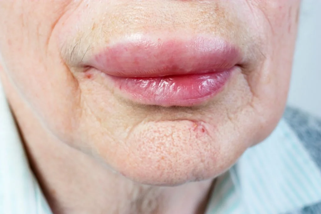 Woman whose lip has swollen suddenly