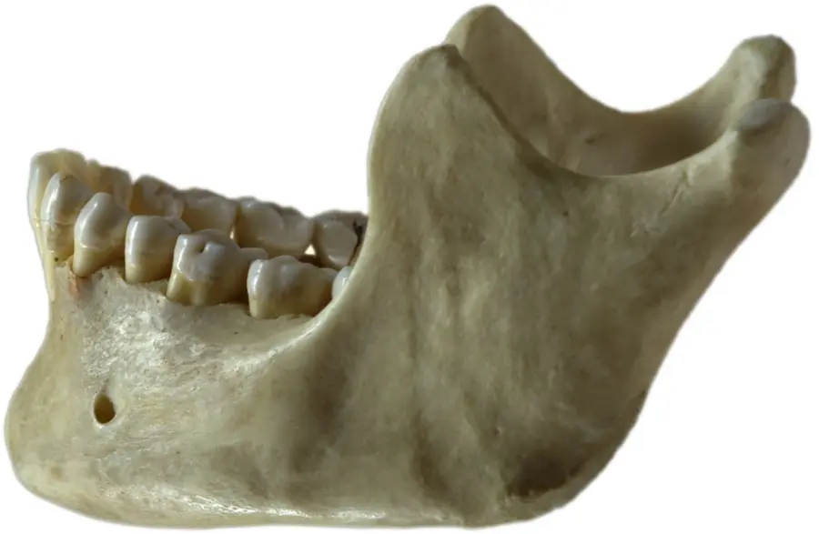 jawbone loss treatment: bone graft and implant planning