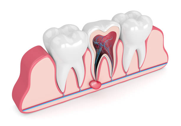 Diagram of a dental cyst developing around a tooth root