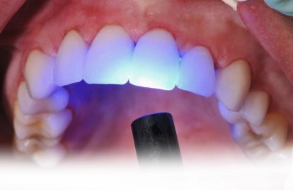Tooth restored with a composite (white) filling