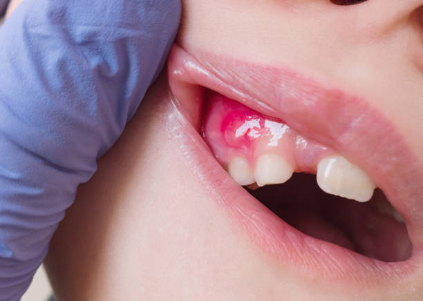 An abscess seen as redness and swelling of the gum in the upper front region