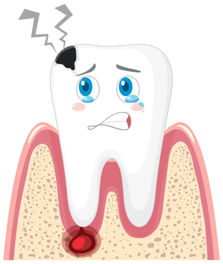 Illustration of a painful tooth and inflammation around the root