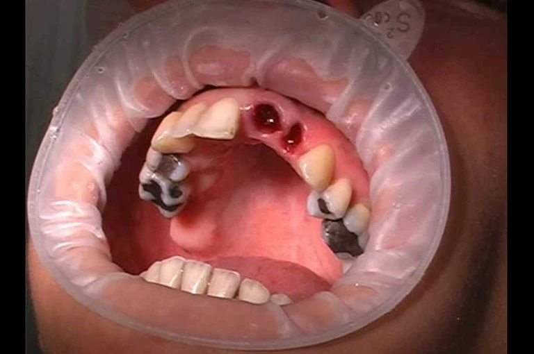 the appearance and signs of dry socket (alveolar osteitis)