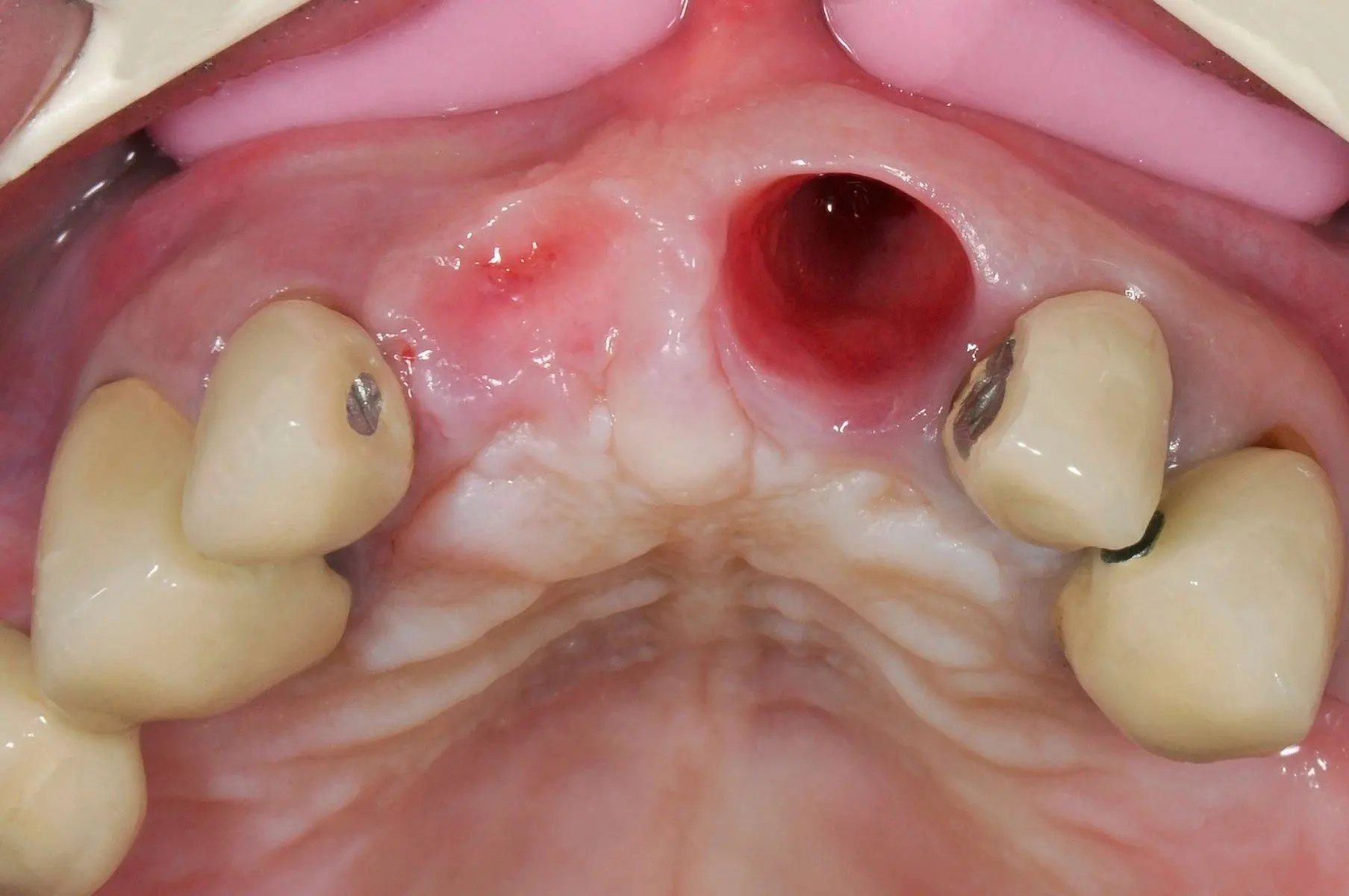 white healing tissue seen in the extraction socket