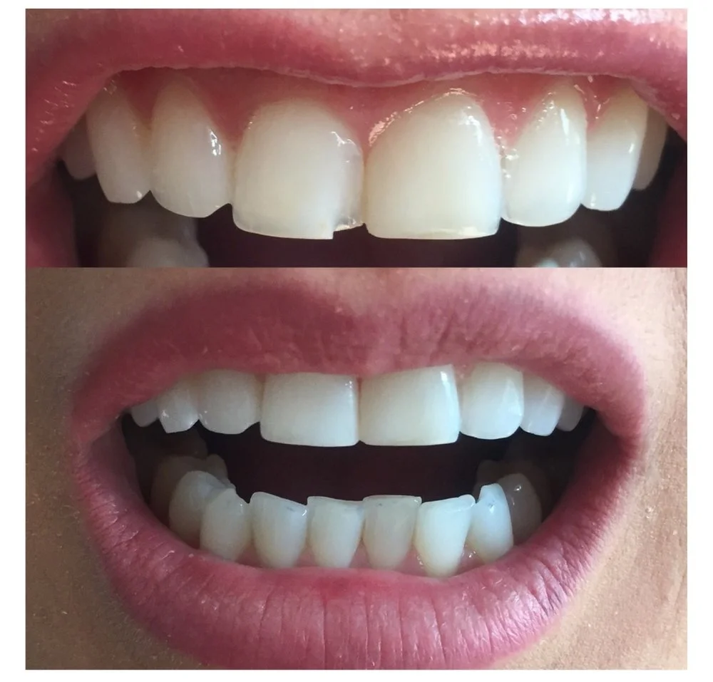 Front teeth restored with composite dental bonding