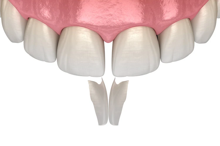 Dental bonding method: curing composite resin with an LED light