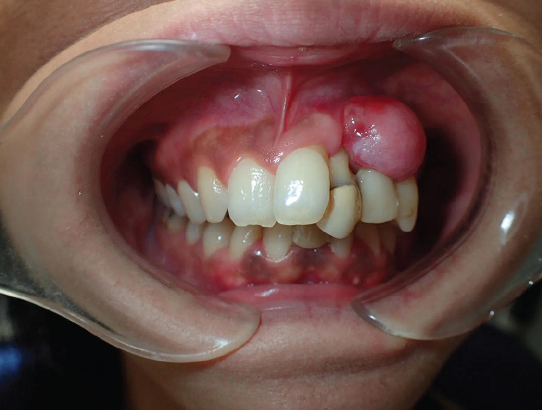 Red and swollen gum tissue