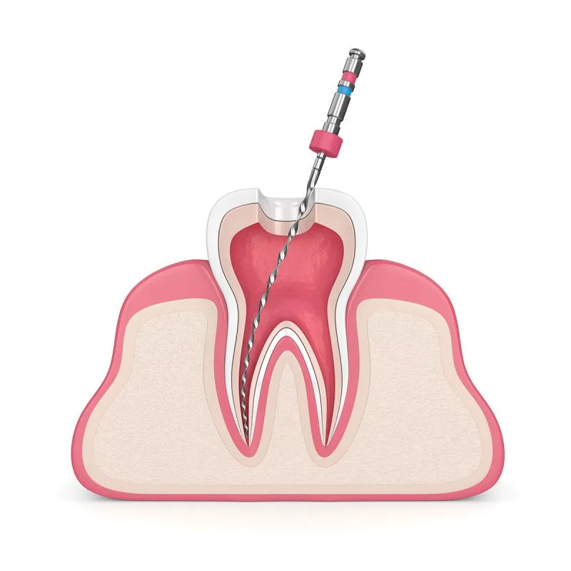photo of a root canal treatment being carried out