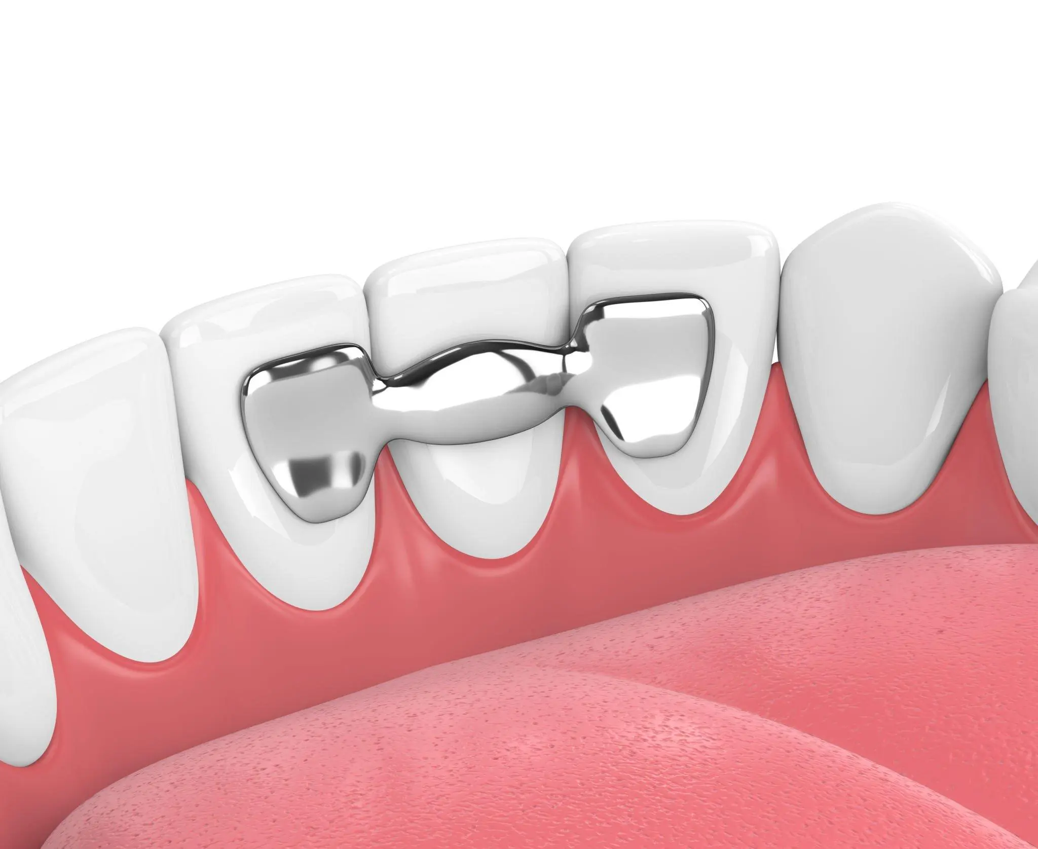 Dental bridge fixed onto the abutment teeth