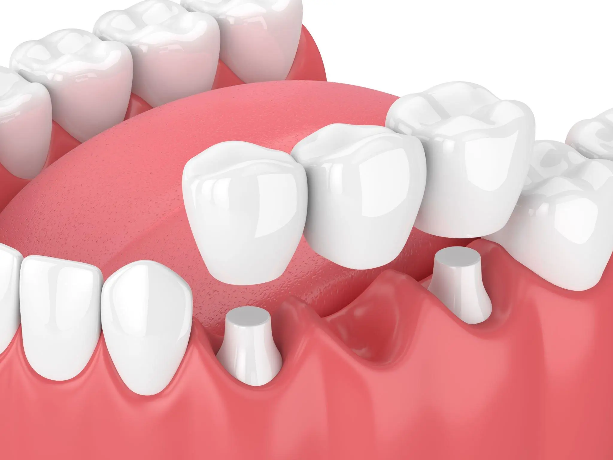 Fixed dental bridge filling the gap left by a missing tooth