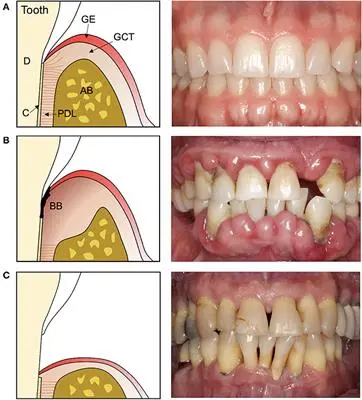 Comparison of closed and open curettage types