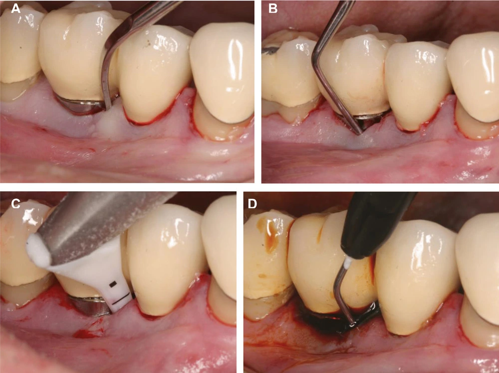 Cleaning the root surface below the gum with curettage