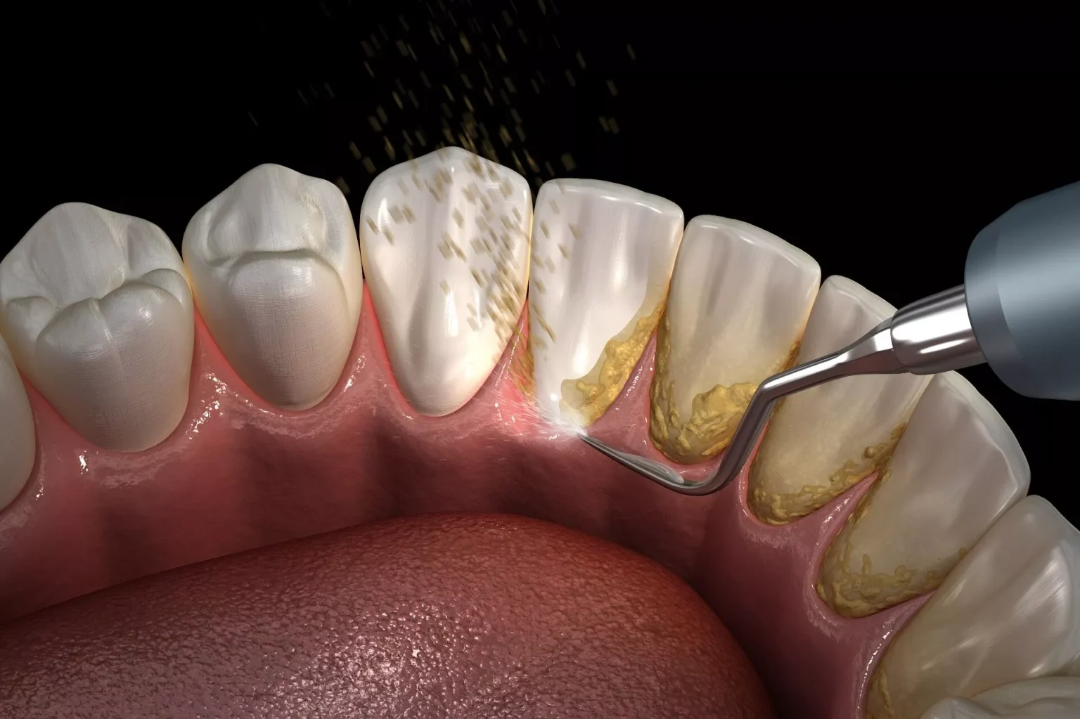 Teeth cleaning procedure and how the teeth look afterwards