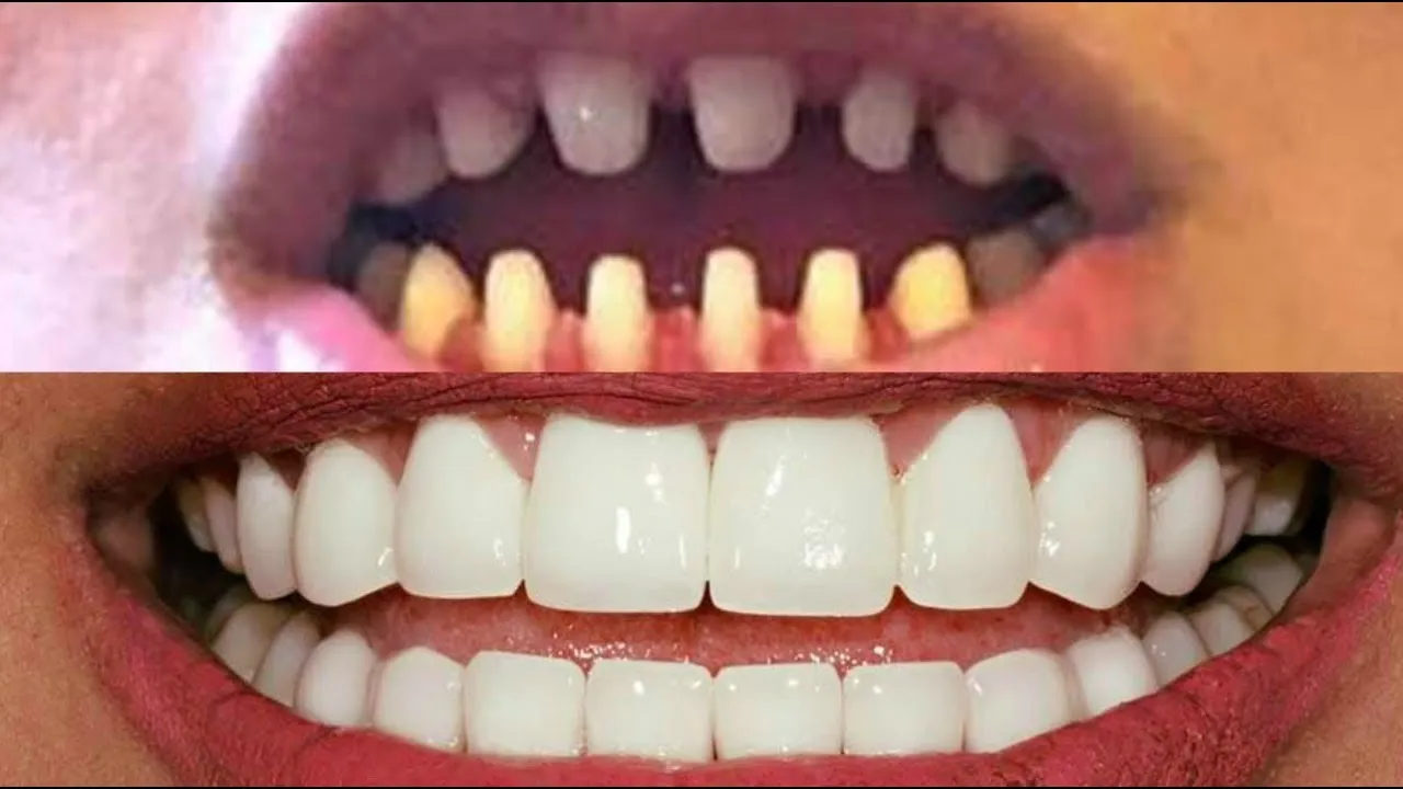 Close-up view of a tooth reshaping procedure