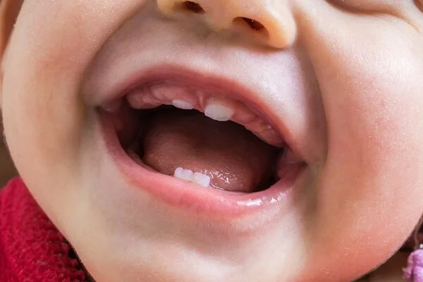 Inside view of a baby's mouth with the first baby teeth erupting in the upper and lower jaw