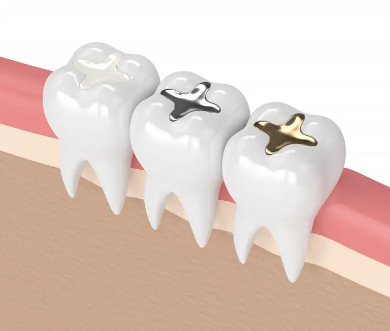 different types of dental fillings