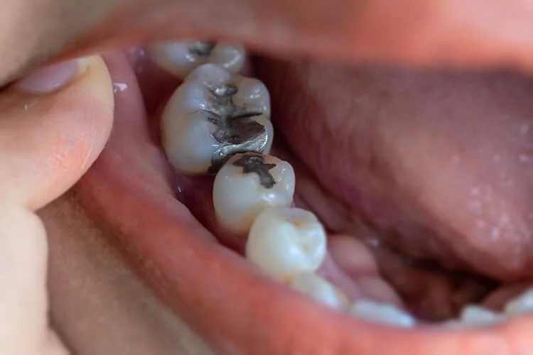 toothache and sensitivity after a filling falls out