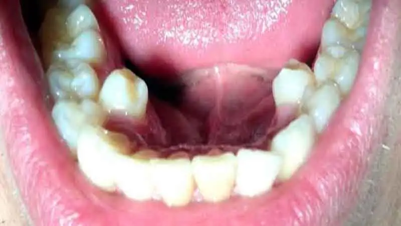 Examples of soft foods after a wisdom tooth extraction