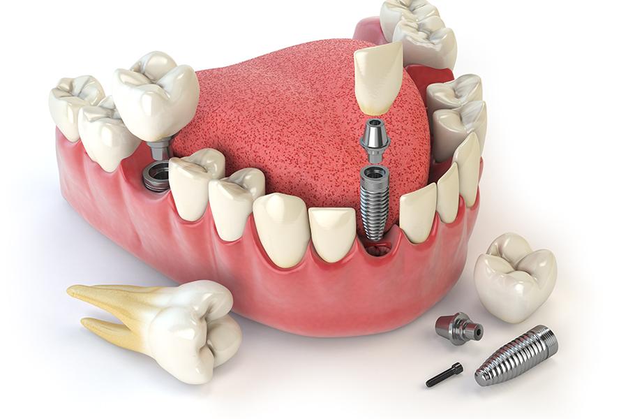 what zirconia crown treatment is