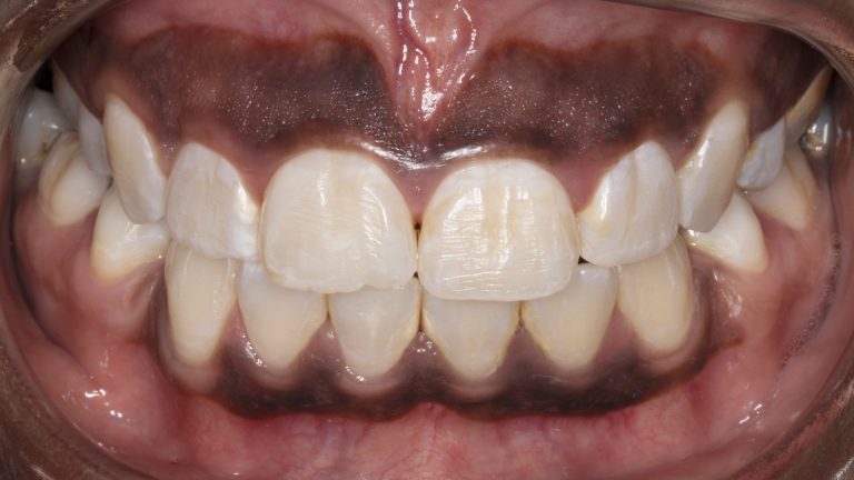 Dentist examining a purple, dark color change in the gum