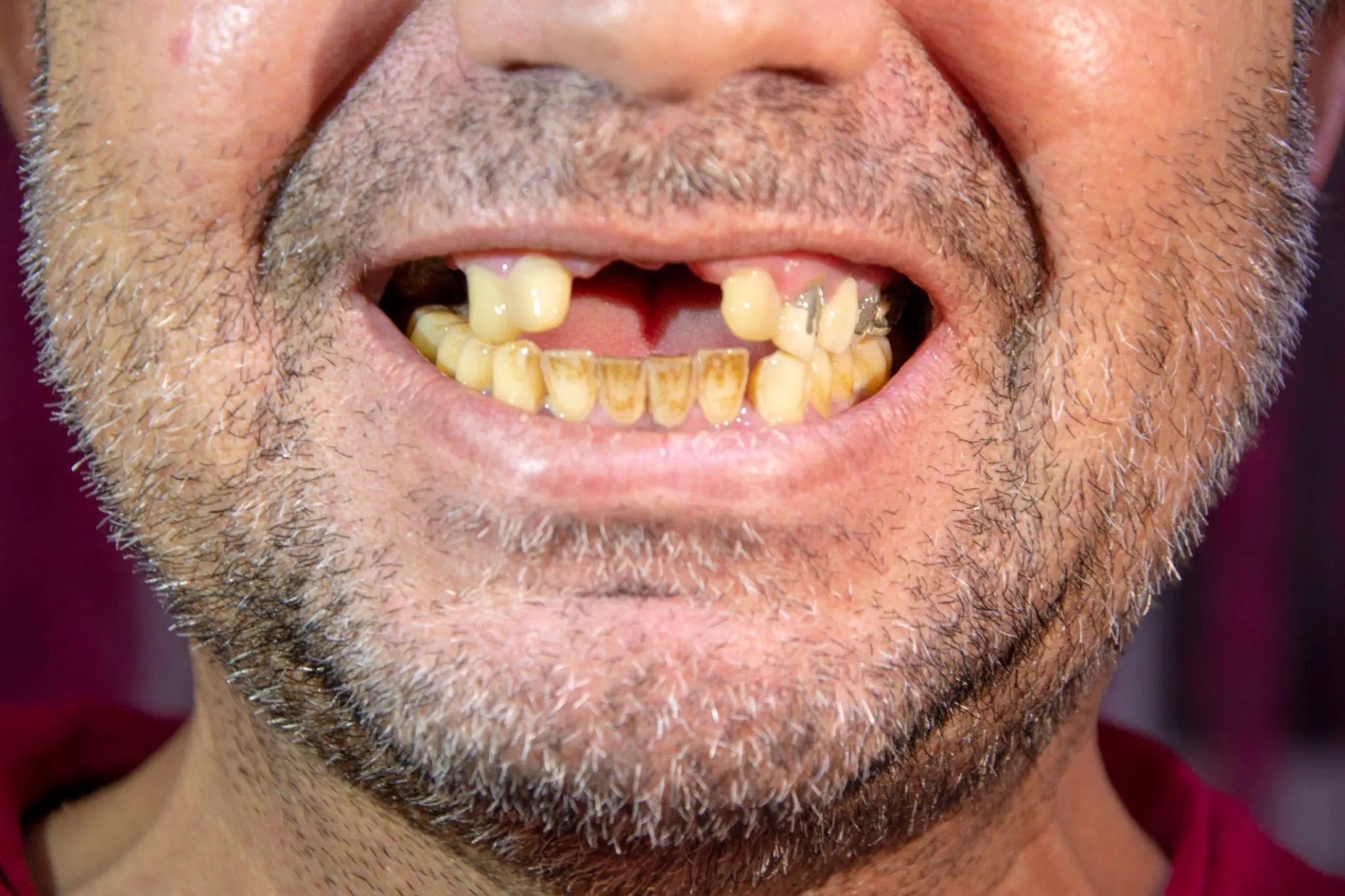 early decay on a front incisor tooth