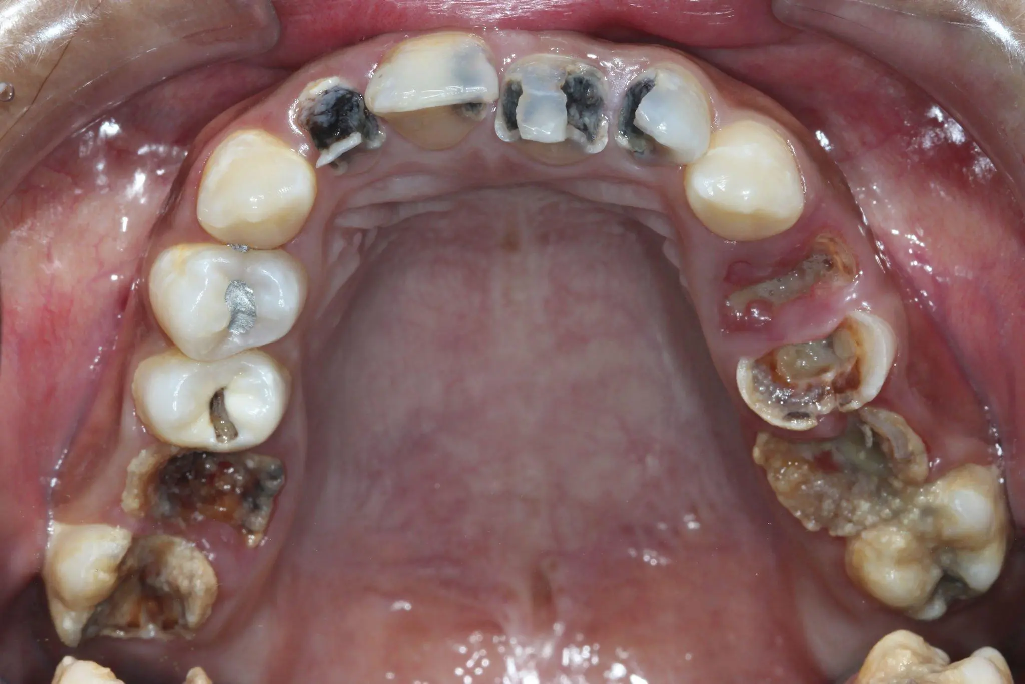 close-up of front tooth decay before treatment