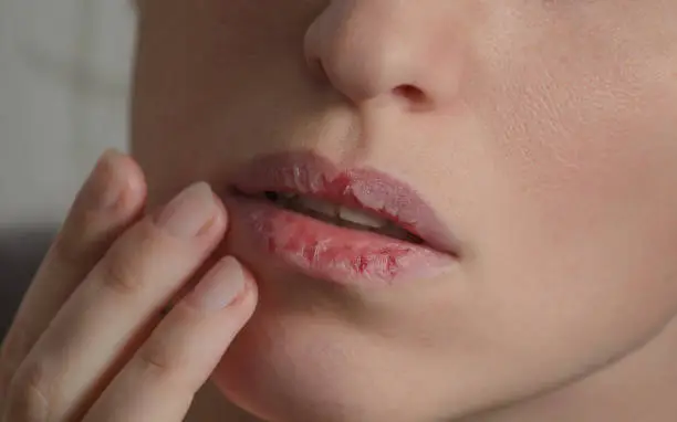 what are the signs of a lip fungal infection
