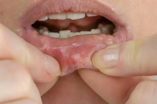what causes a lip fungal infection