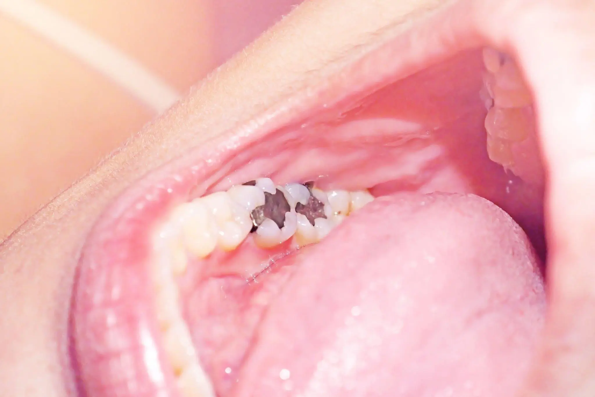 Photograph of a gray metallic amalgam (silver) filling in a back molar