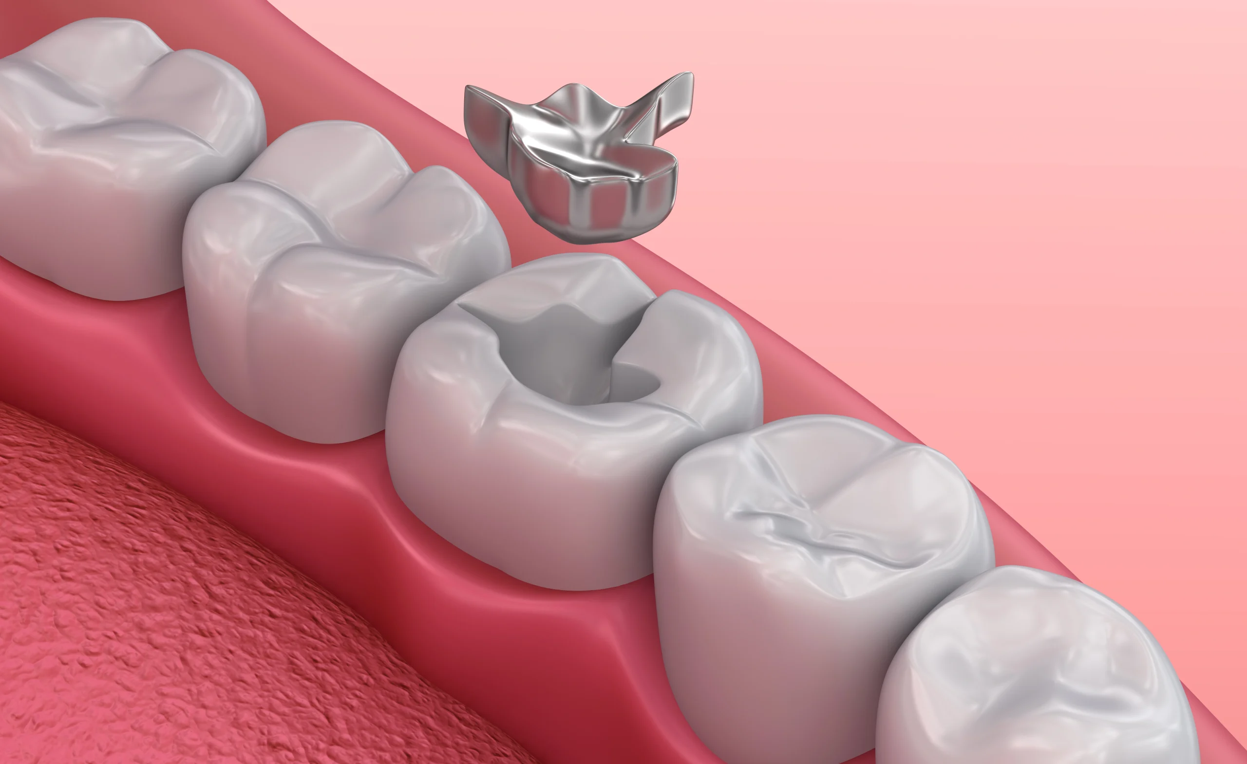 Amalgam filling safety and mercury content: dental examination