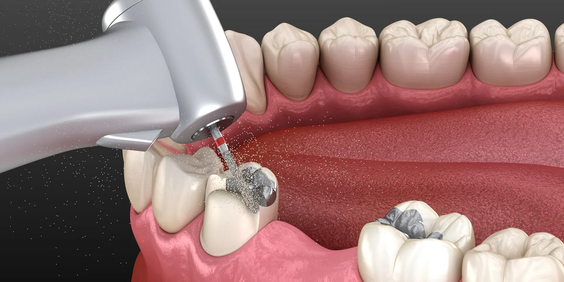 Comparison of an amalgam filling and a tooth-colored composite filling