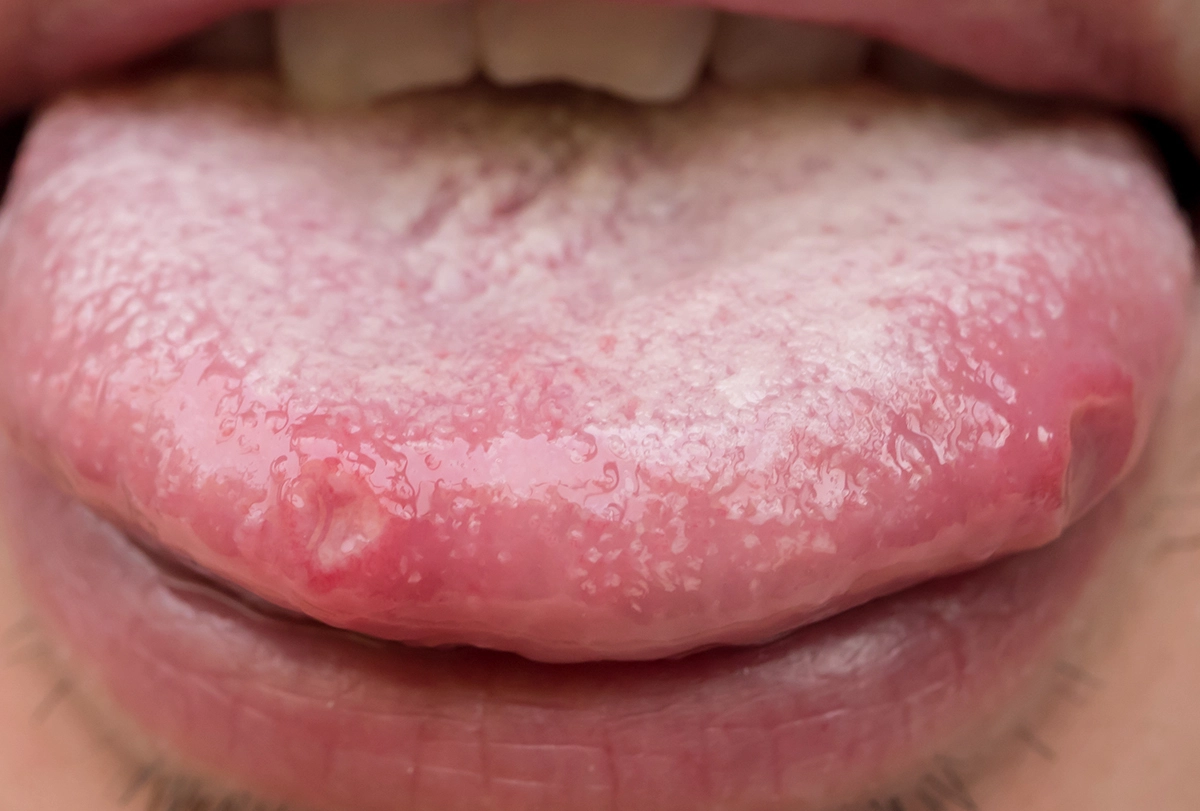 Gentle oral care with a soft brush to help a tongue sore heal